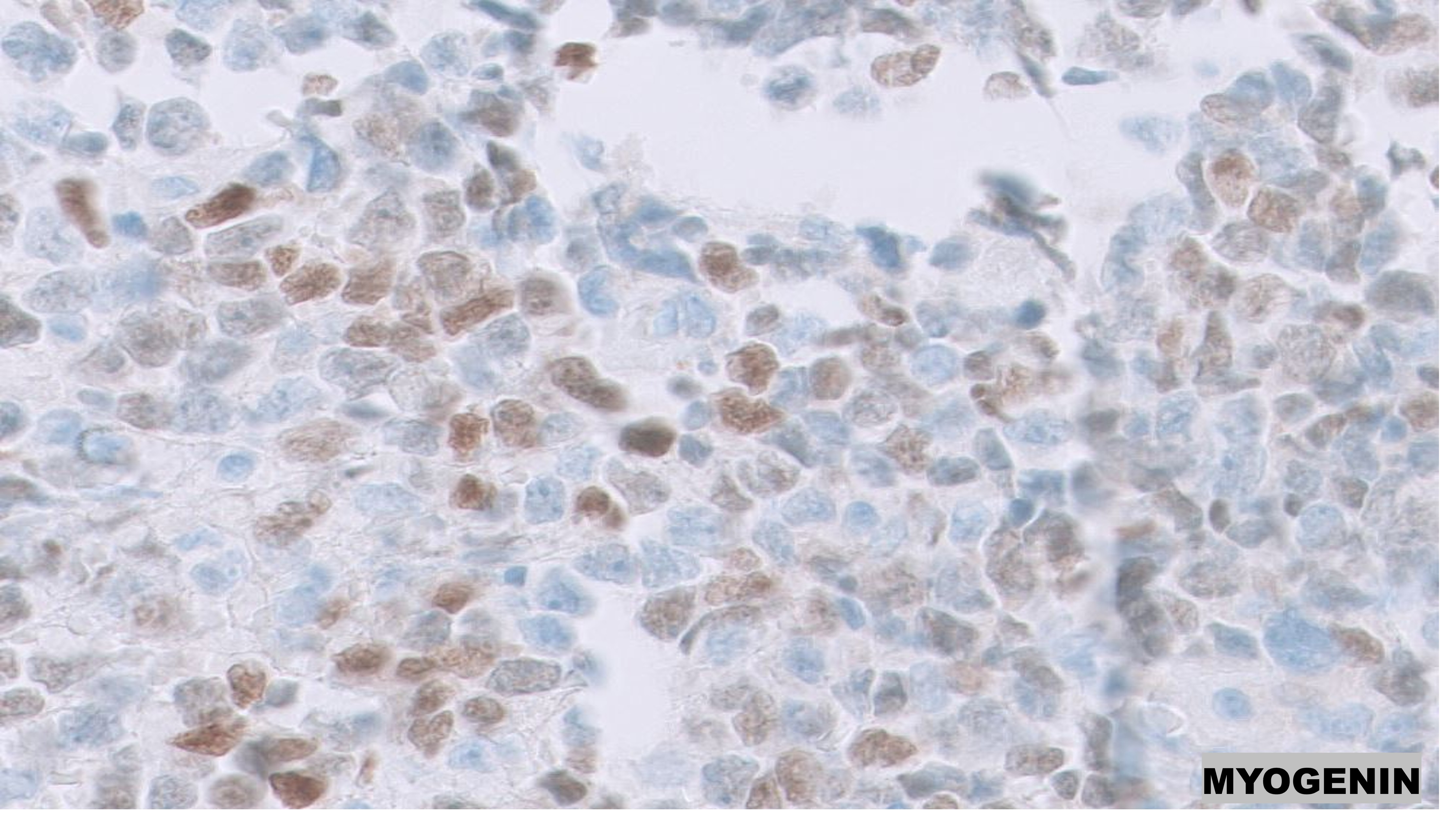 Microscopic image possibly detecting cancerous areas in human tissue