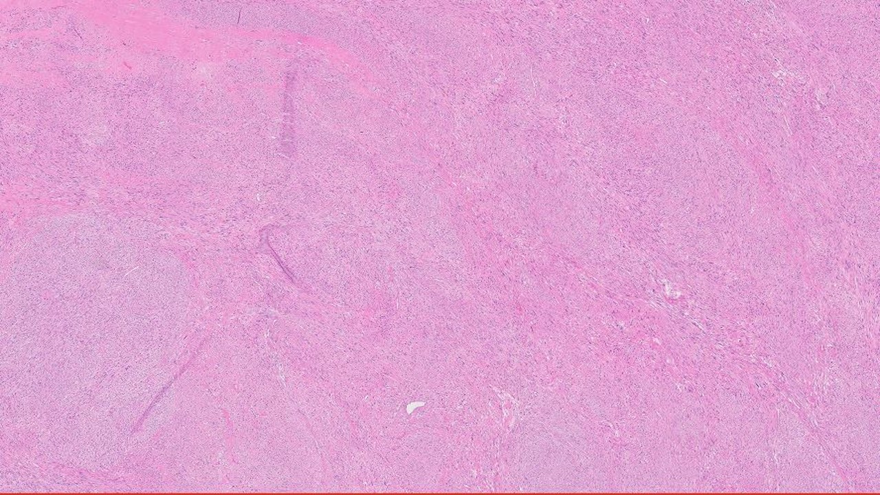 Microscopic image possibly detecting cancerous areas in human tissue