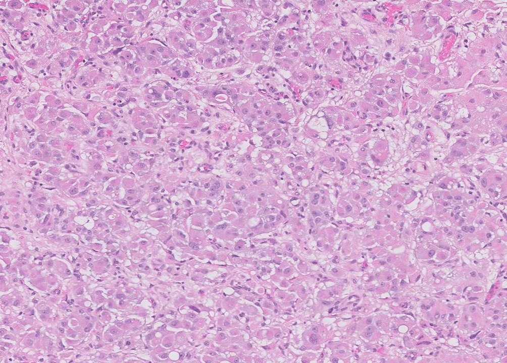 Microscopic image possibly detecting cancerous areas in human tissue