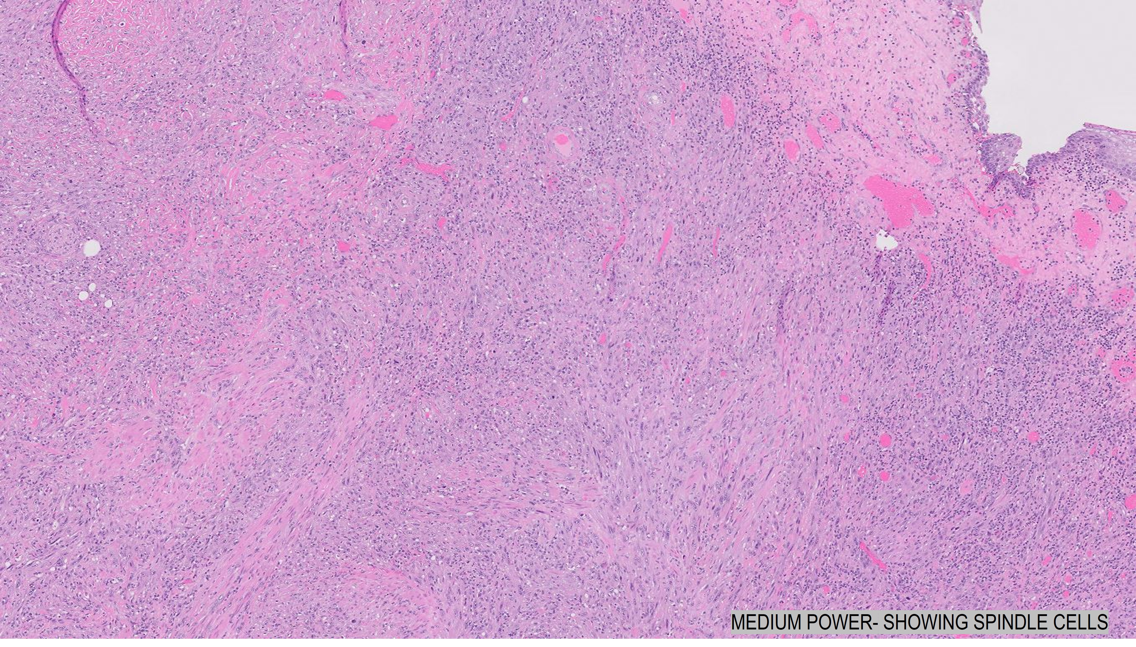 Microscopic image possibly detecting cancerous areas in human tissue