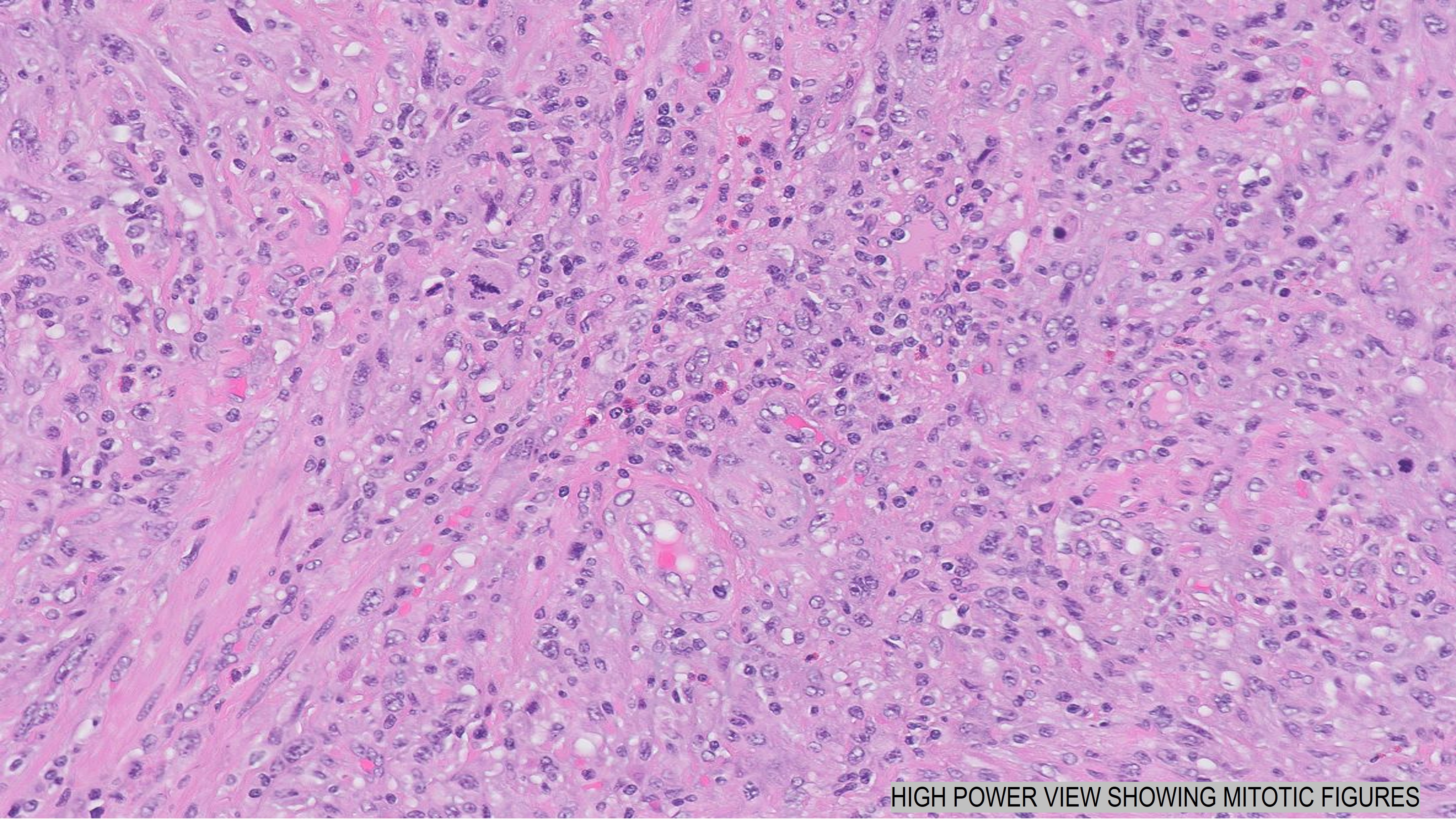 Microscopic image possibly detecting cancerous areas in human tissue