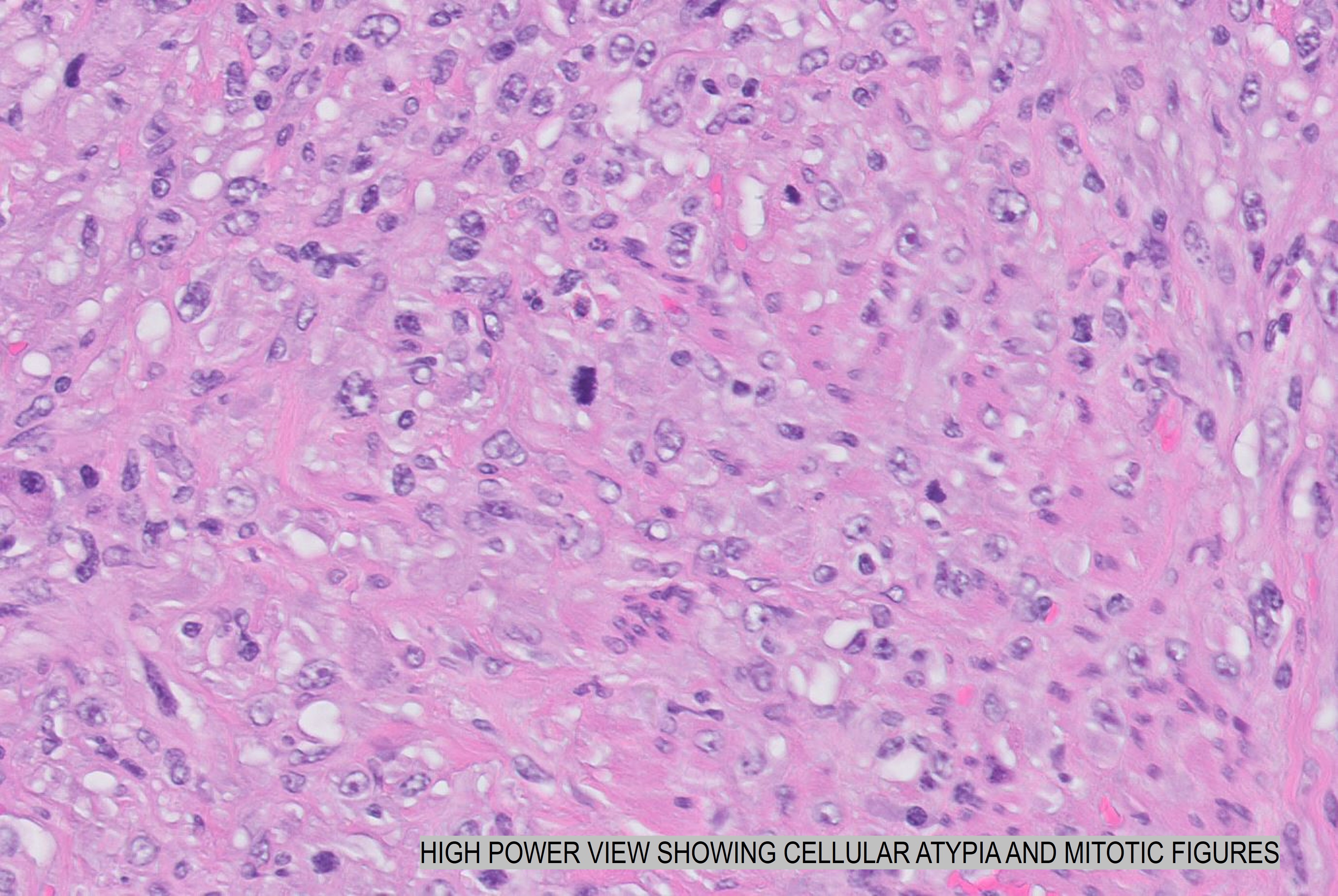 Microscopic image possibly detecting cancerous areas in human tissue