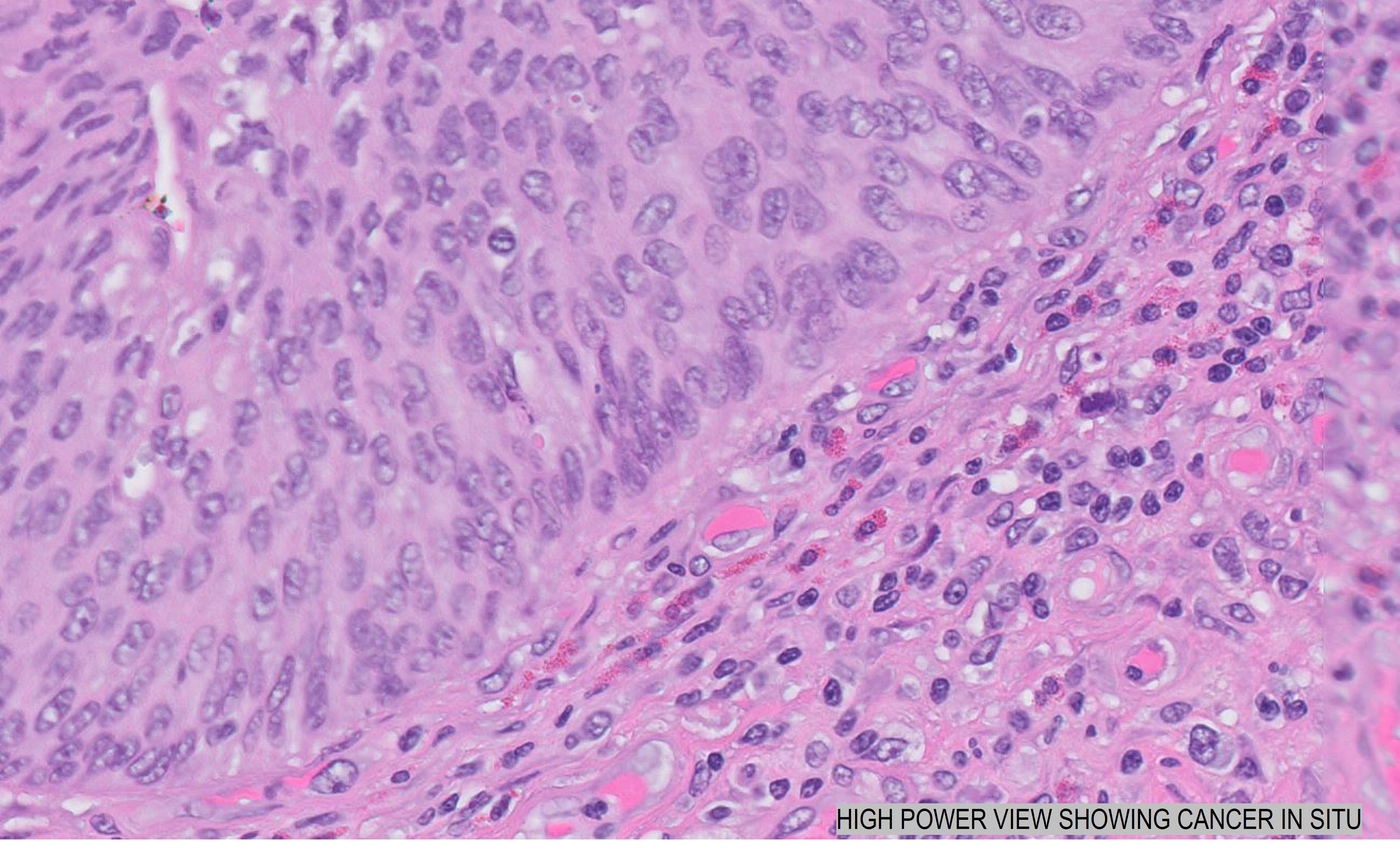 Microscopic image possibly detecting cancerous areas in human tissue