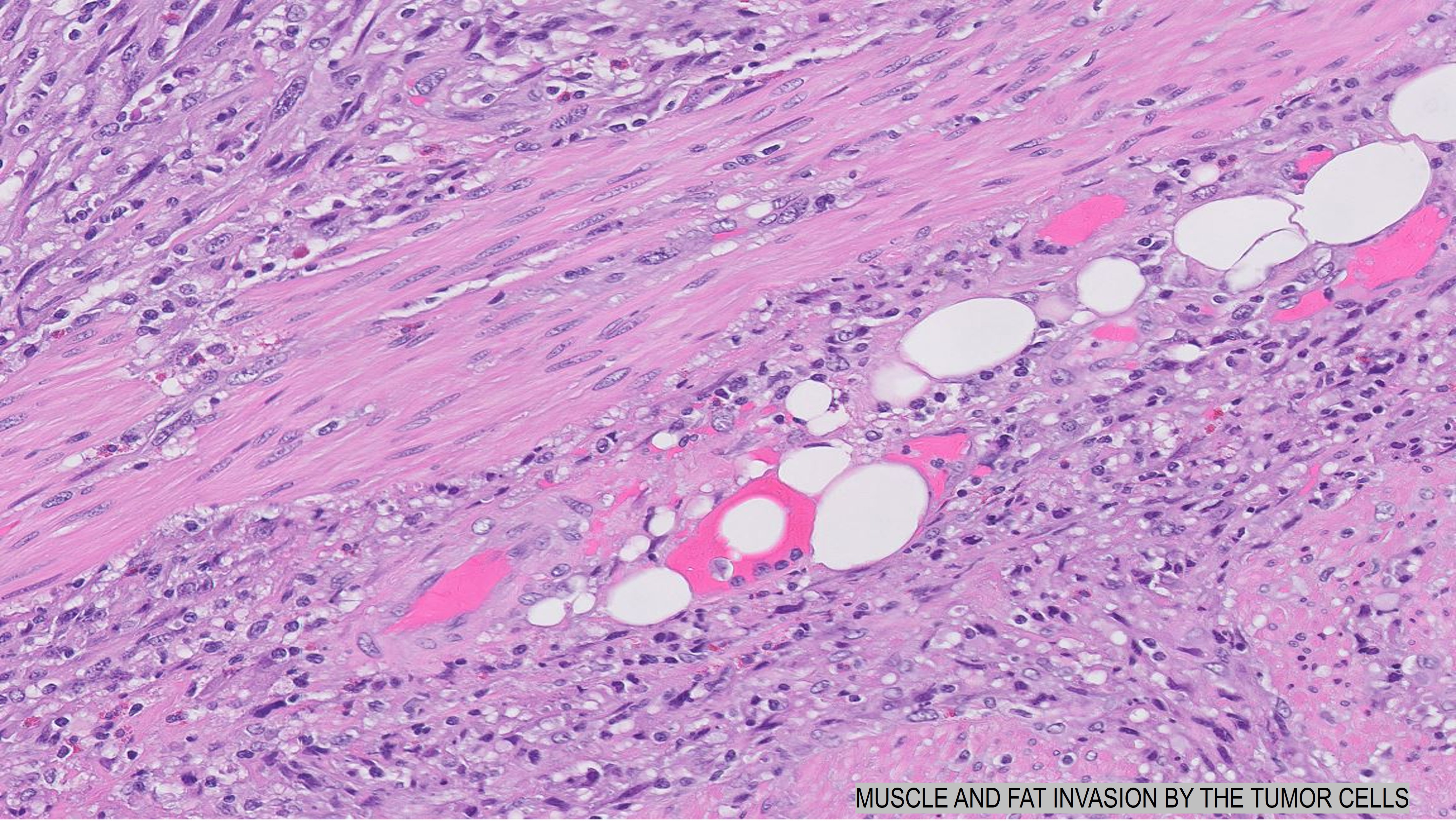 Microscopic image possibly detecting cancerous areas in human tissue
