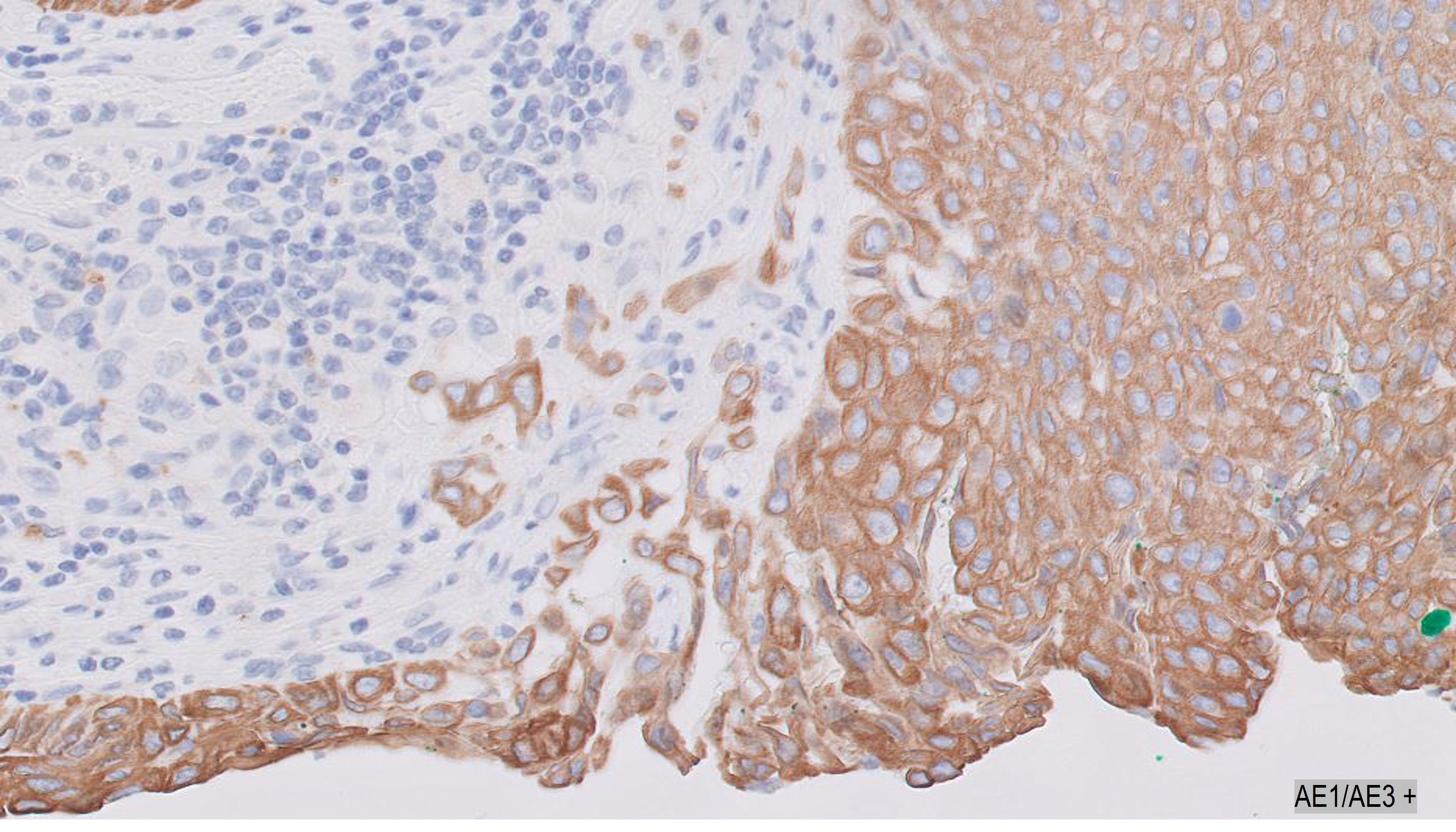 Microscopic image possibly detecting cancerous areas in human tissue