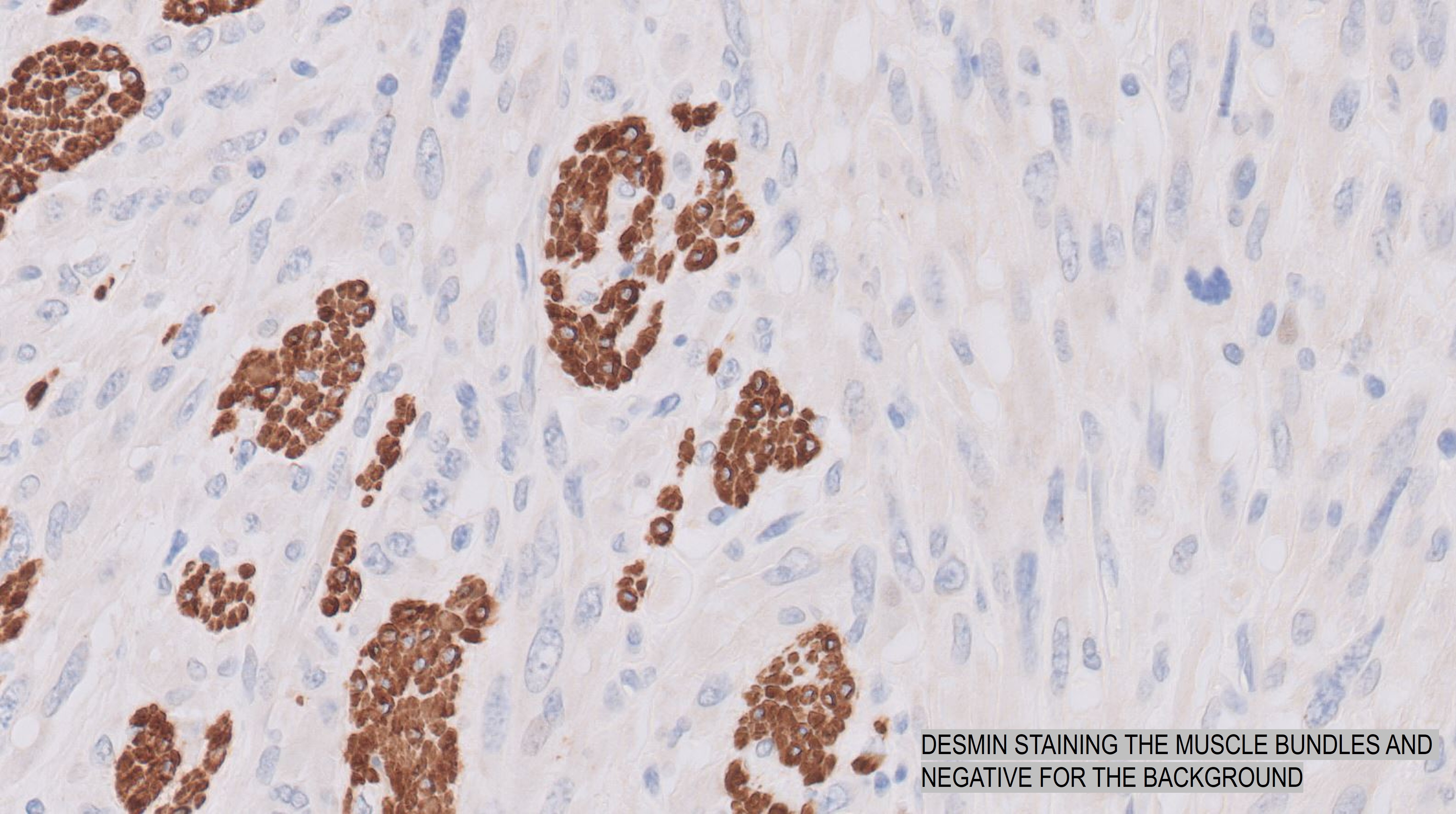 Microscopic image possibly detecting cancerous areas in human tissue