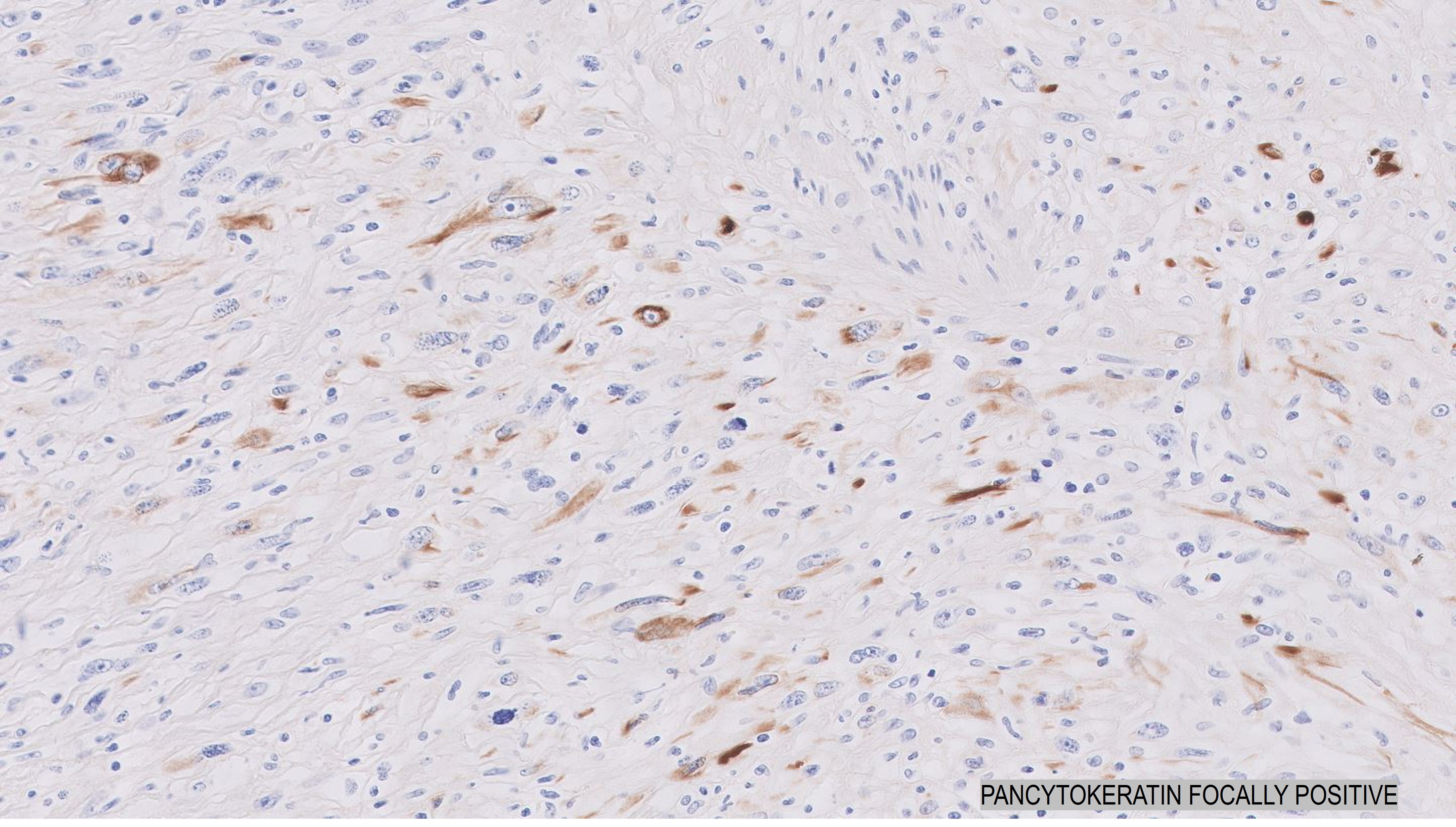 Microscopic image possibly detecting cancerous areas in human tissue