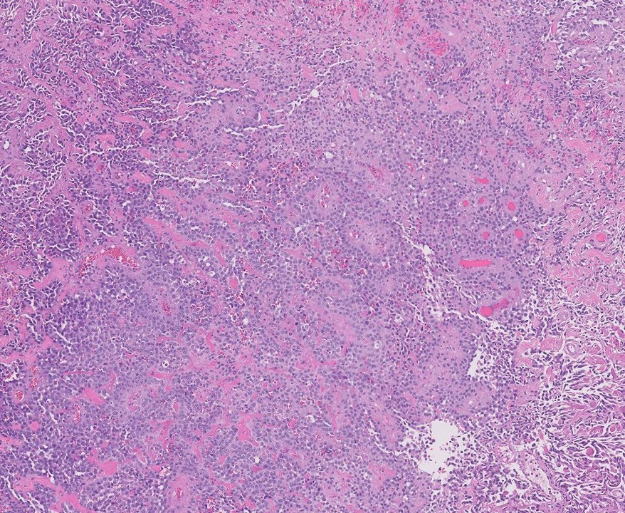 Microscopic image possibly detecting cancerous areas in human tissue