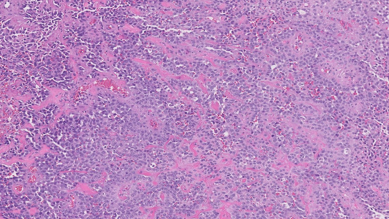 Microscopic image possibly detecting cancerous areas in human tissue