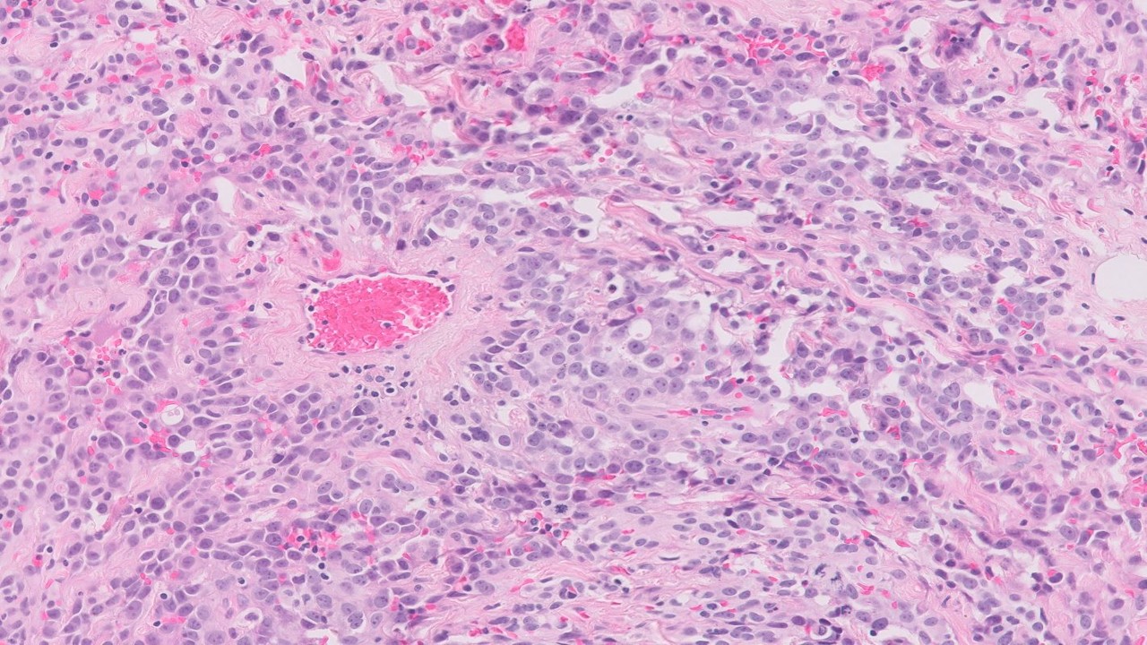 Microscopic image possibly detecting cancerous areas in human tissue