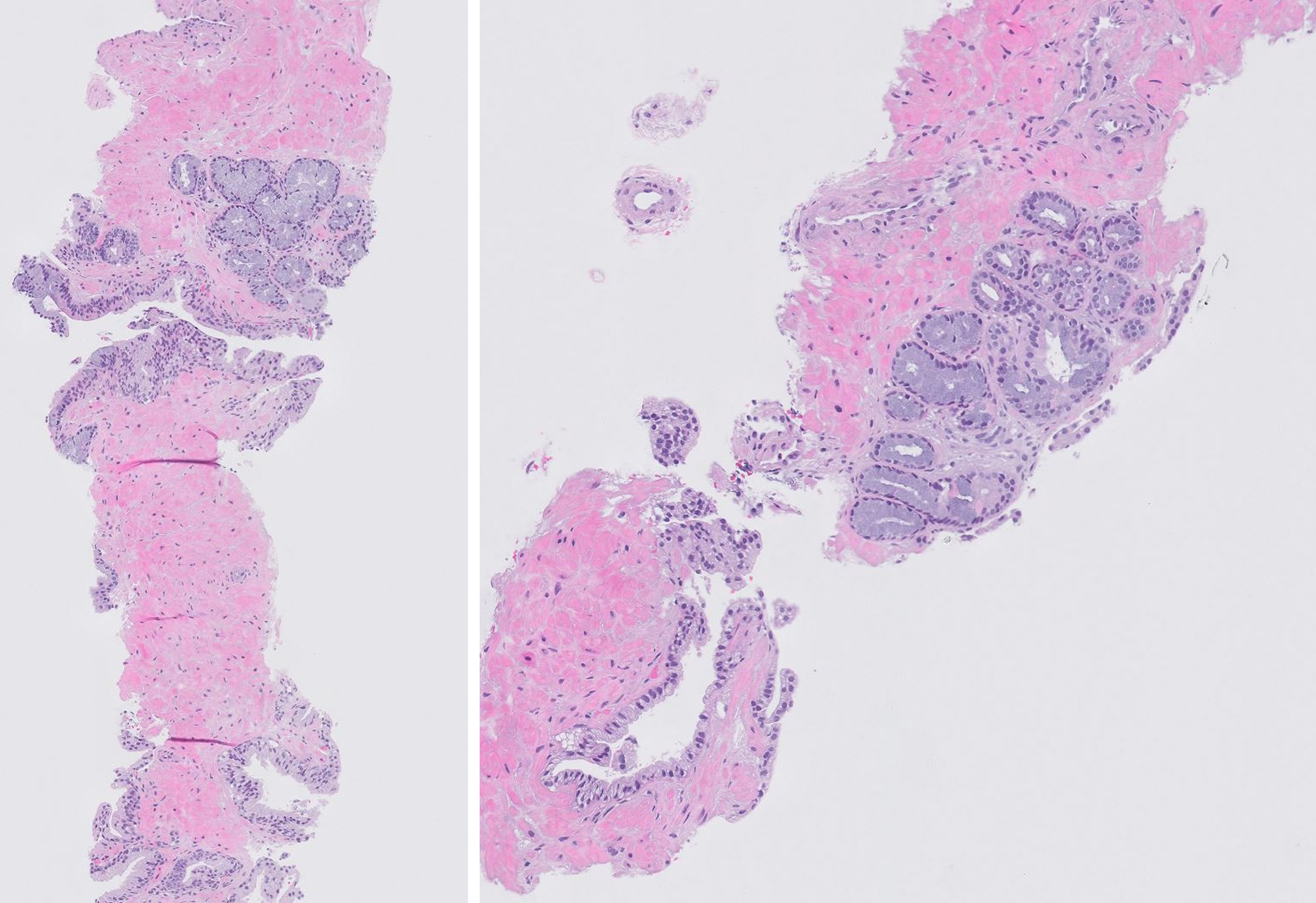 Microscopic image possibly detecting cancerous areas in human tissue