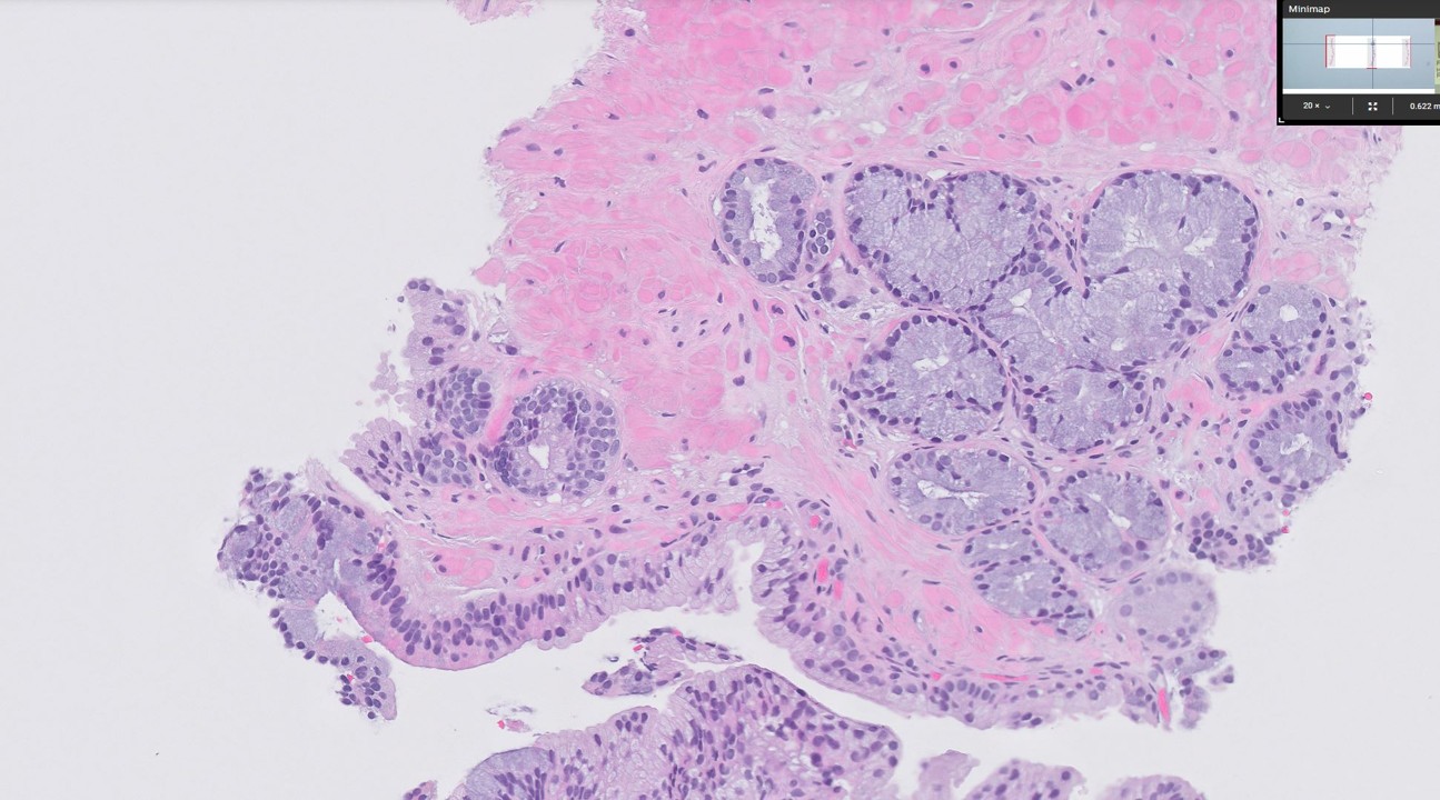 Microscopic image possibly detecting cancerous areas in human tissue
