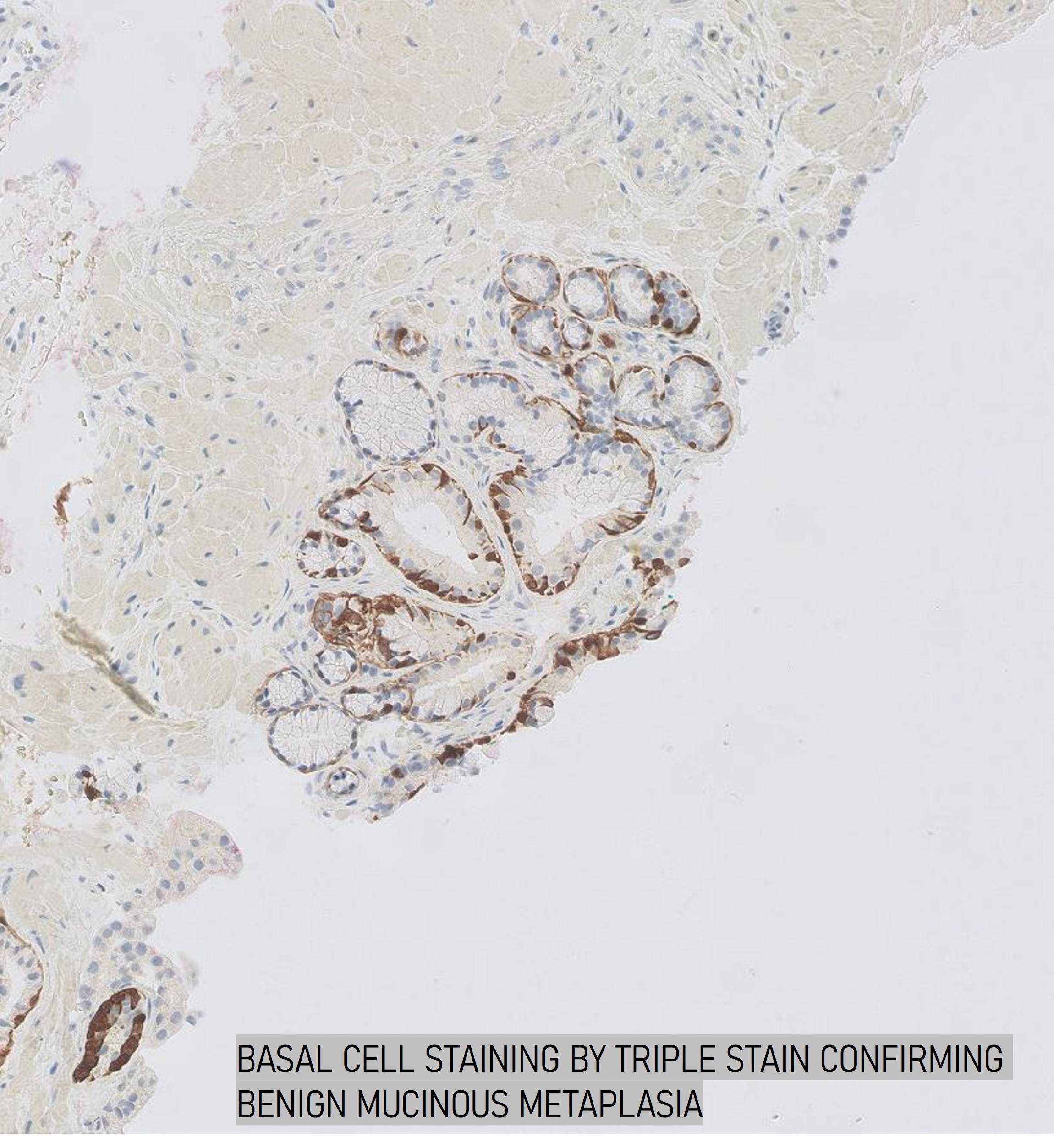 Microscopic image possibly detecting cancerous areas in human tissue
