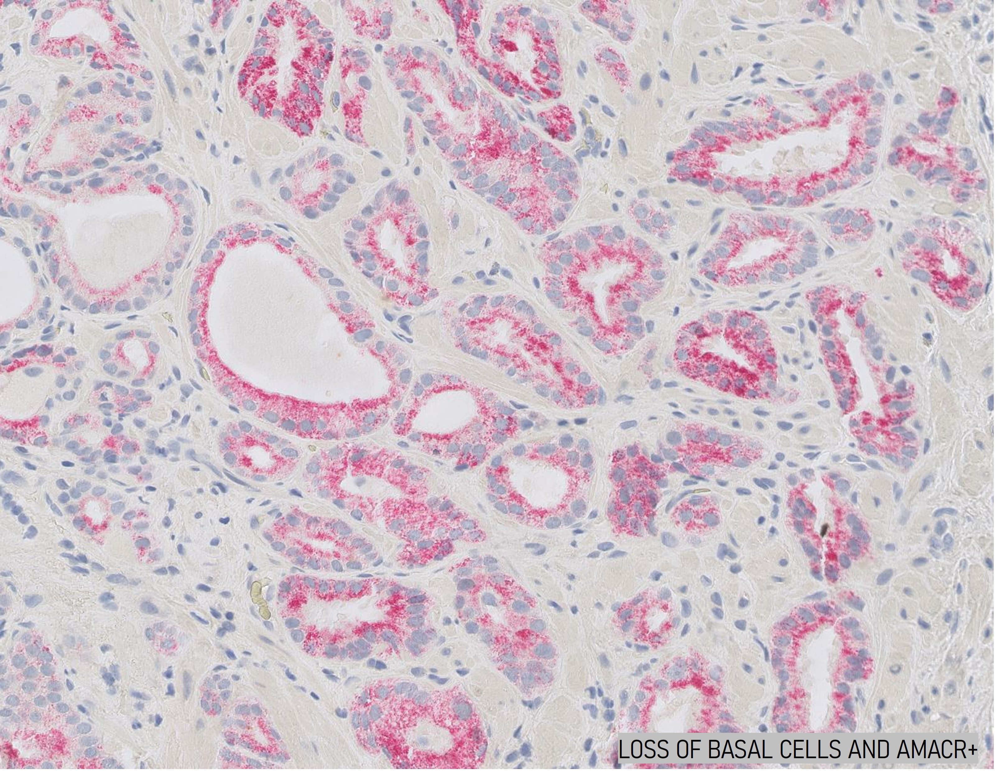 Microscopic image possibly detecting cancerous areas in human tissue