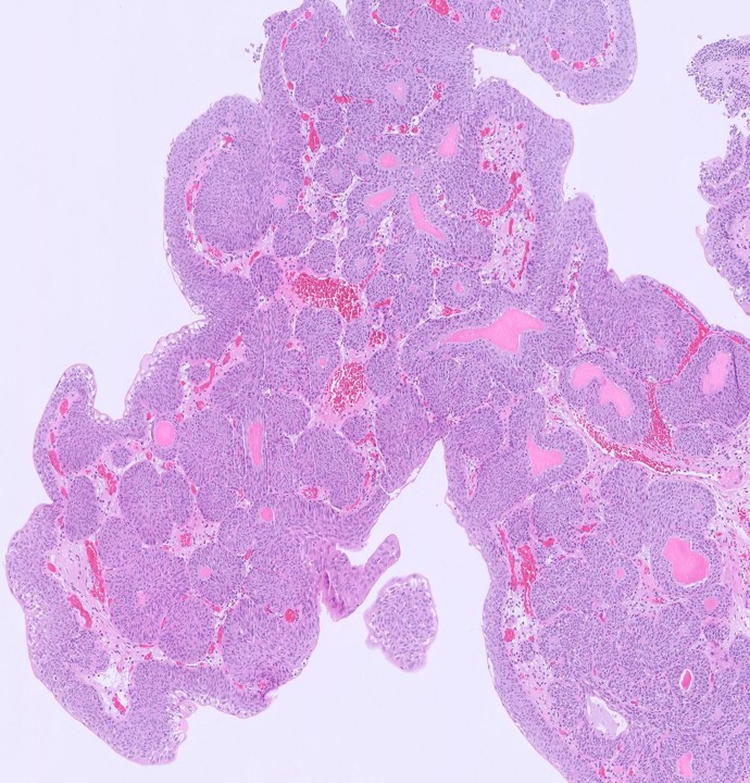 Microscopic image possibly detecting cancerous areas in human tissue