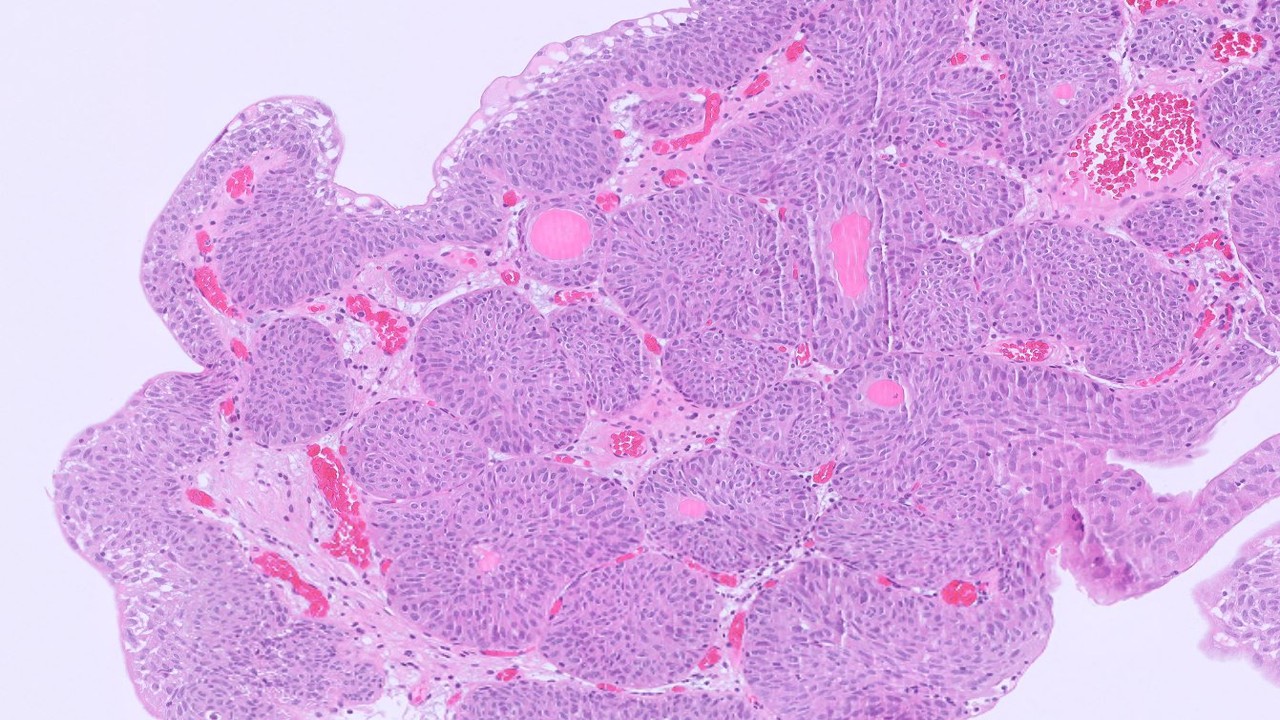 Microscopic image possibly detecting cancerous areas in human tissue