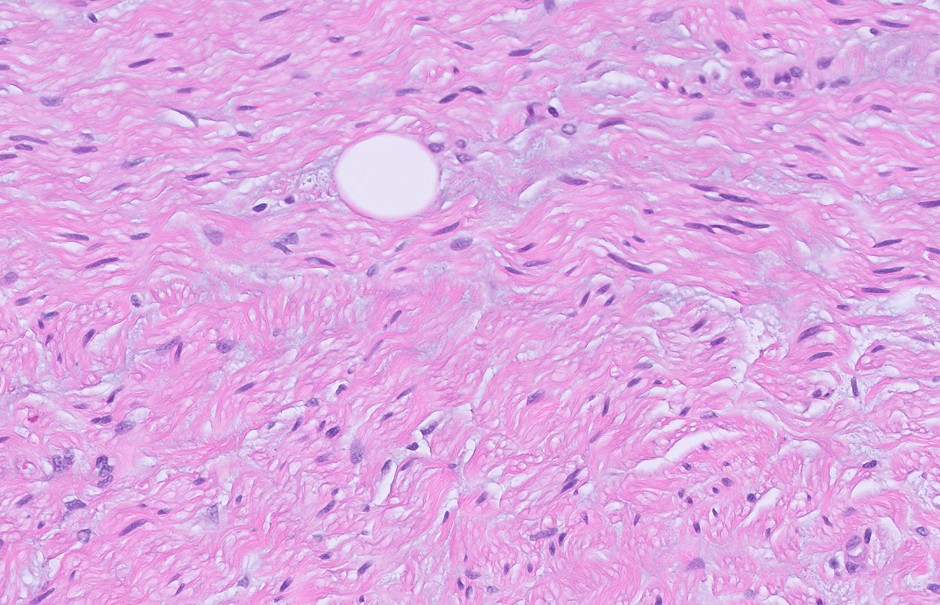 Microscopic image possibly detecting cancerous areas in human tissue