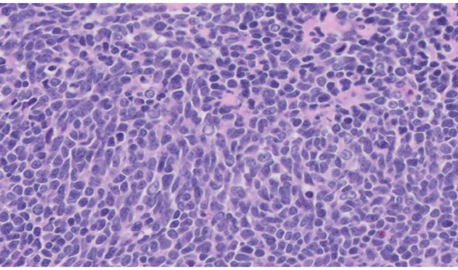 Microscopic image possibly detecting cancerous areas in human tissue