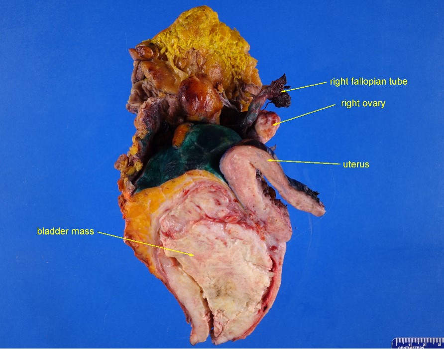 Gross image of bladder