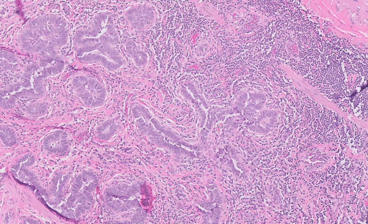 Microscopic image possibly detecting cancerous areas in human tissue