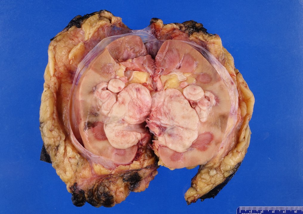 Gross image of kidney