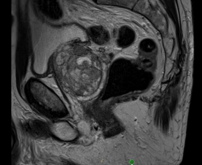 CT scan of prostrate