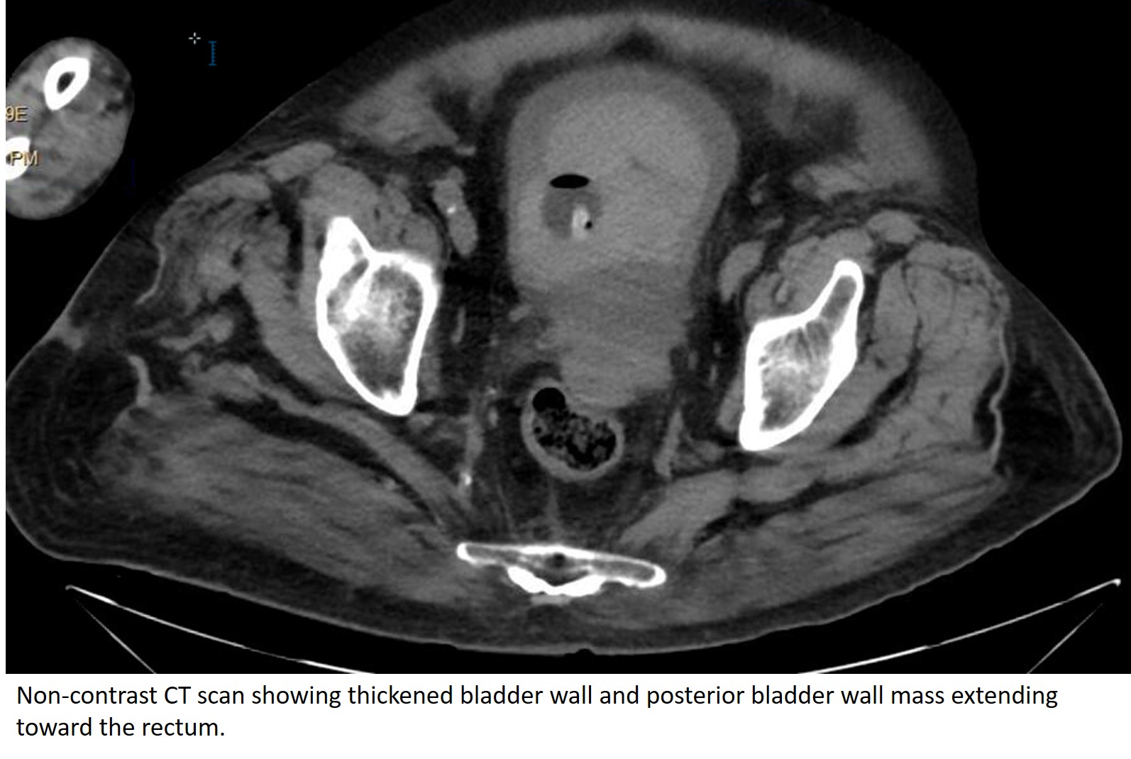 CT scan of bladder