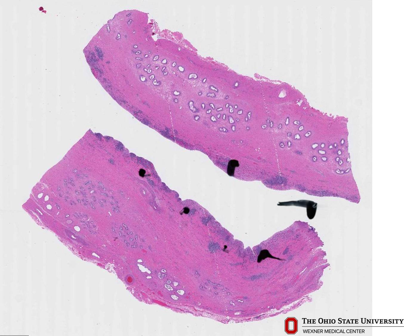 Microscopic image possibly detecting cancerous areas in human tissue