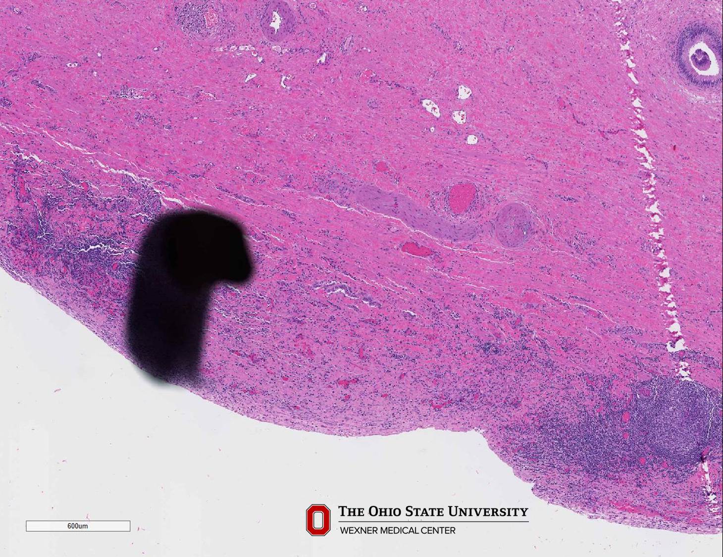 Microscopic image possibly detecting cancerous areas in human tissue