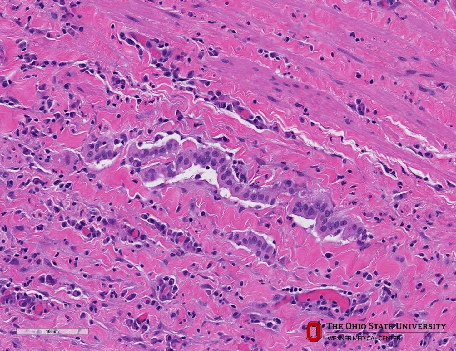 Microscopic image possibly detecting cancerous areas in human tissue