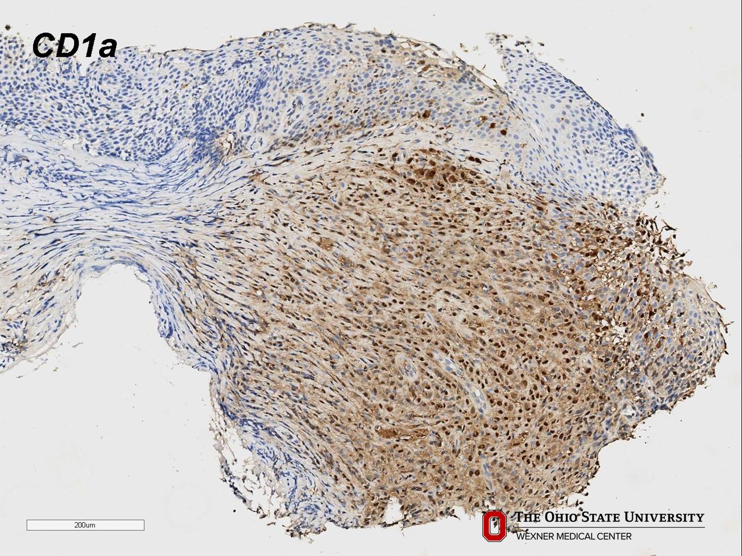 Microscopic image possibly detecting cancerous areas in human tissue