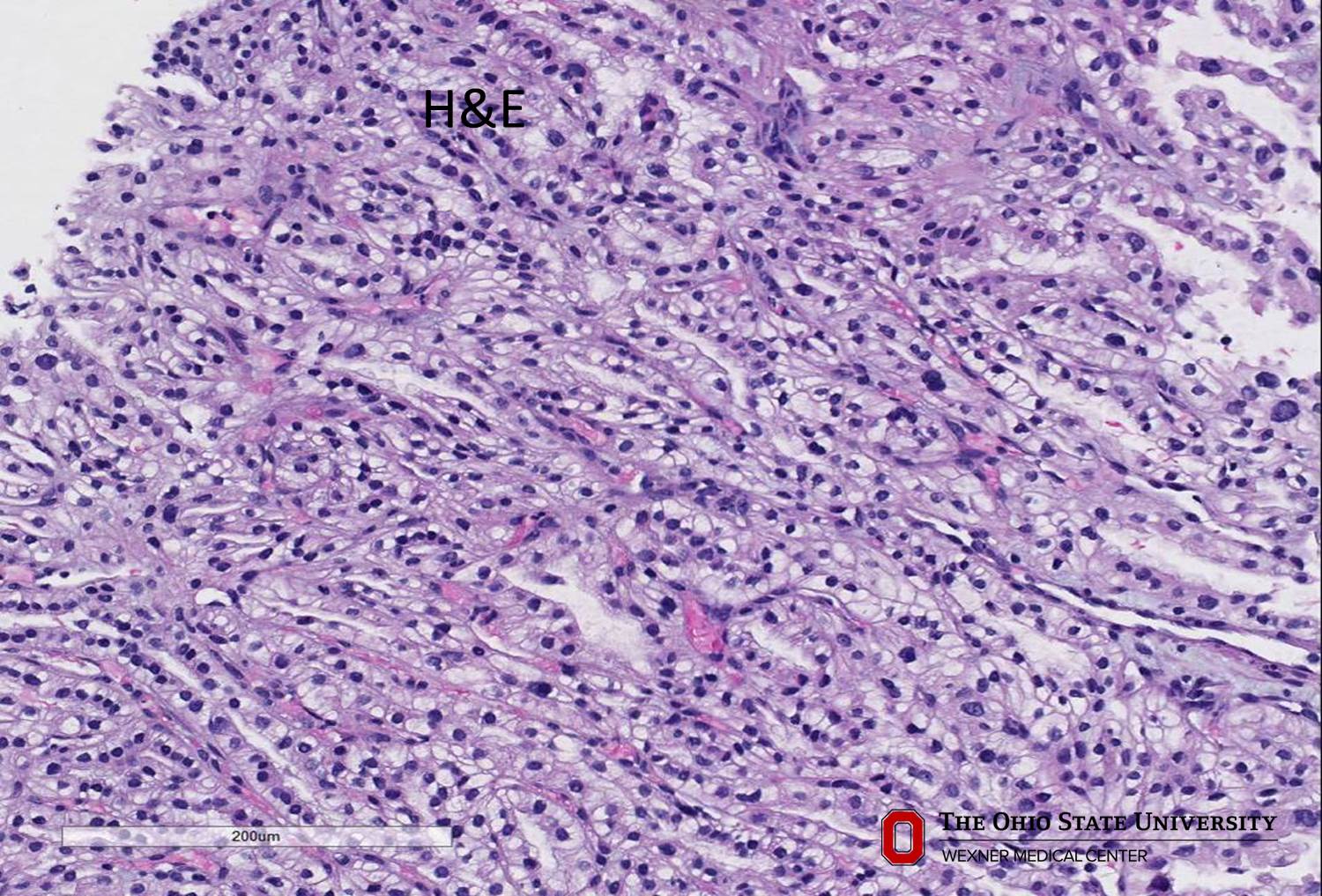 Microscopic image possibly detecting cancerous areas in human tissue