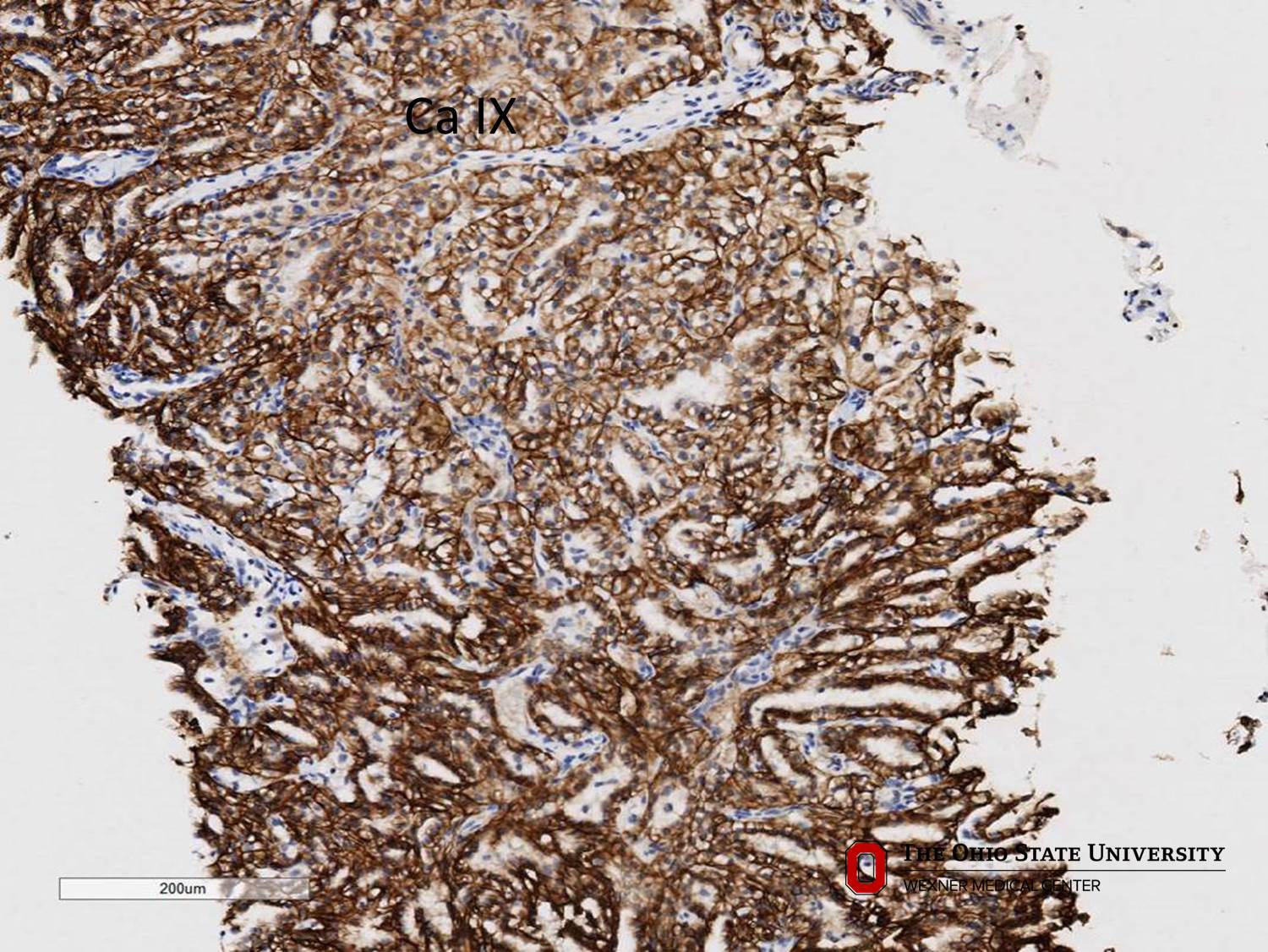 Microscopic image possibly detecting cancerous areas in human tissue