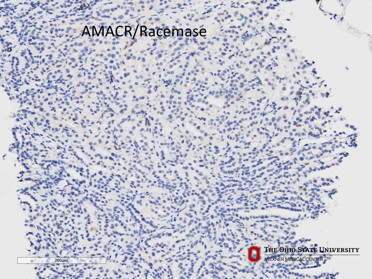 Microscopic image possibly detecting cancerous areas in human tissue