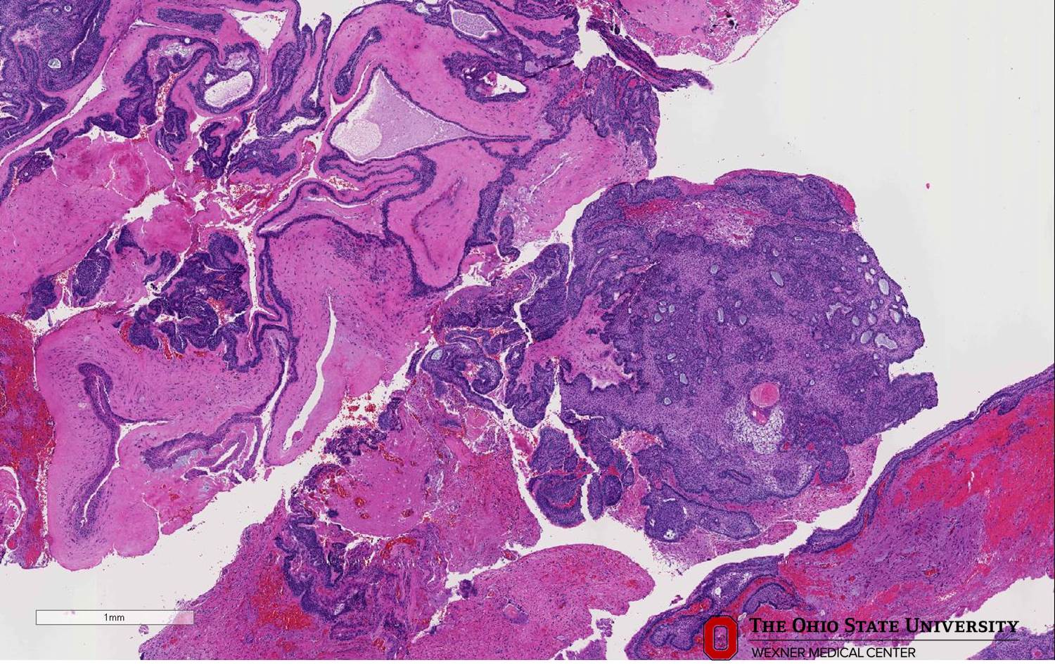 Microscopic image possibly detecting cancerous areas in human tissue