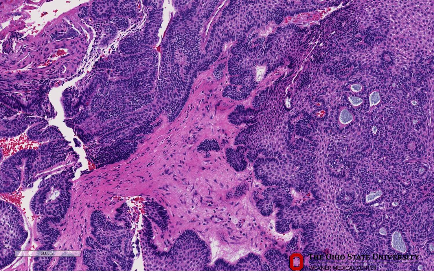 Microscopic image possibly detecting cancerous areas in human tissue