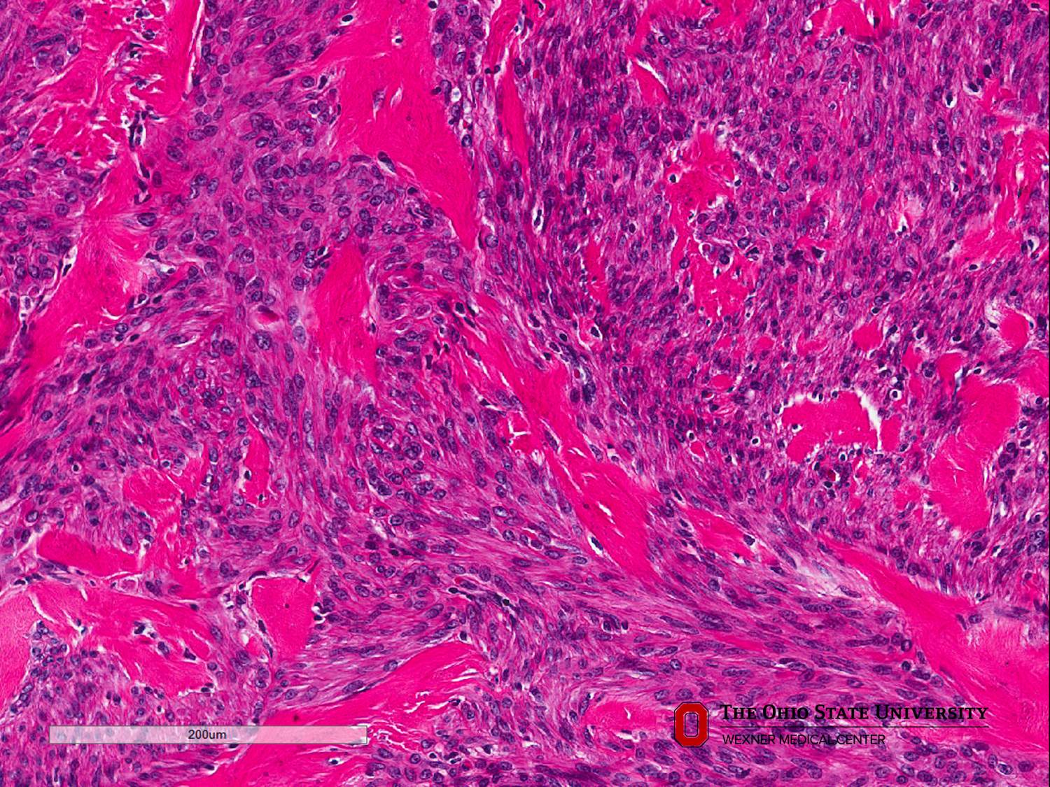 Microscopic image possibly detecting cancerous areas in human tissue