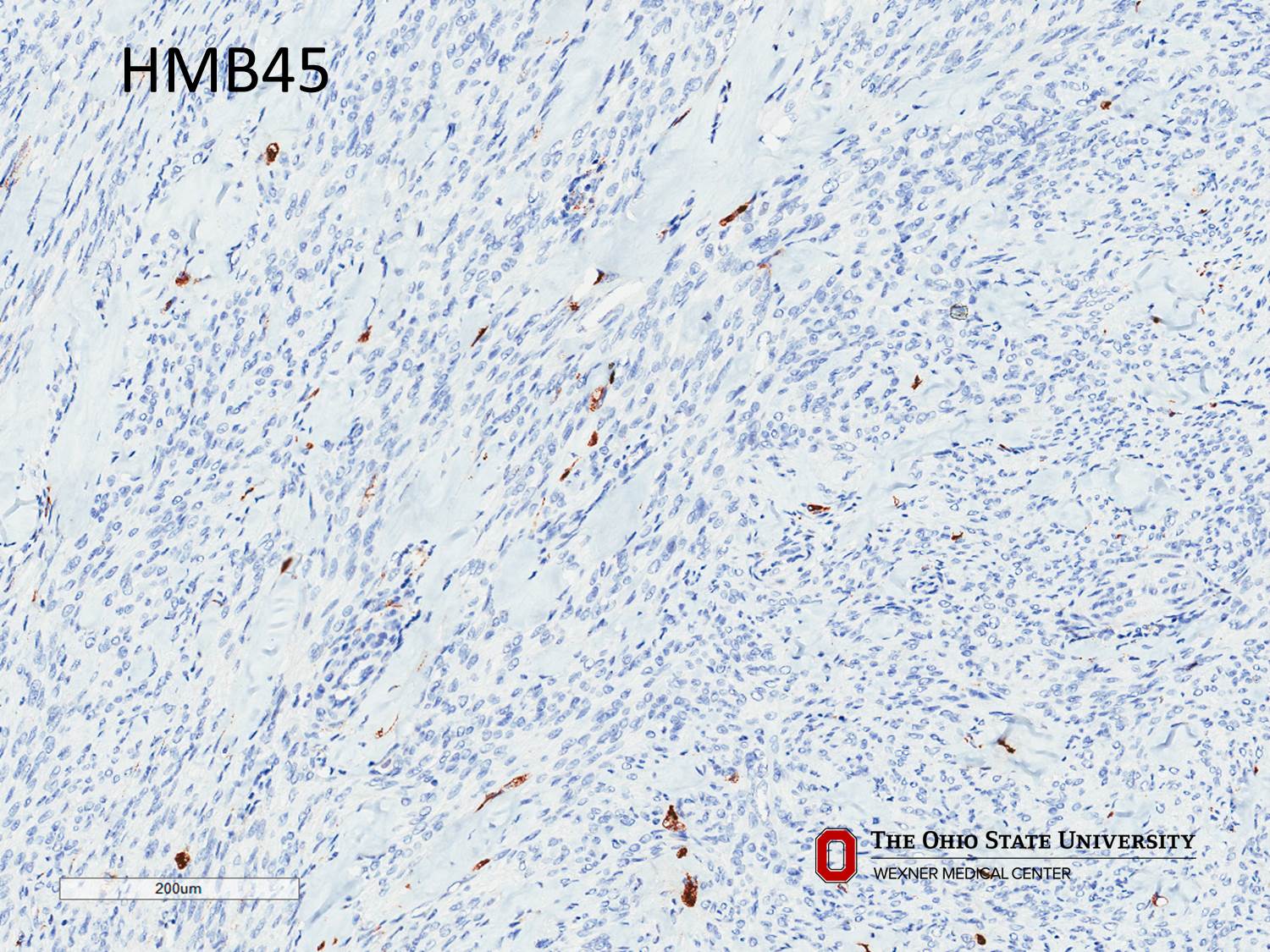 Microscopic image possibly detecting cancerous areas in human tissue