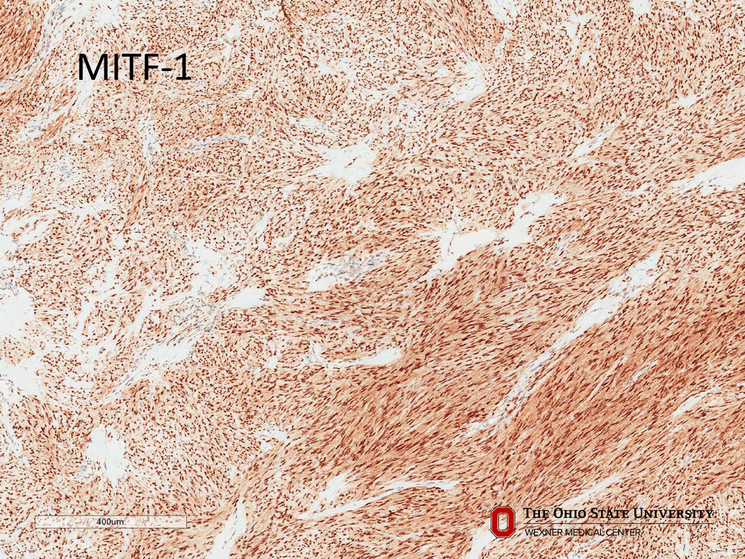 Microscopic image possibly detecting cancerous areas in human tissue