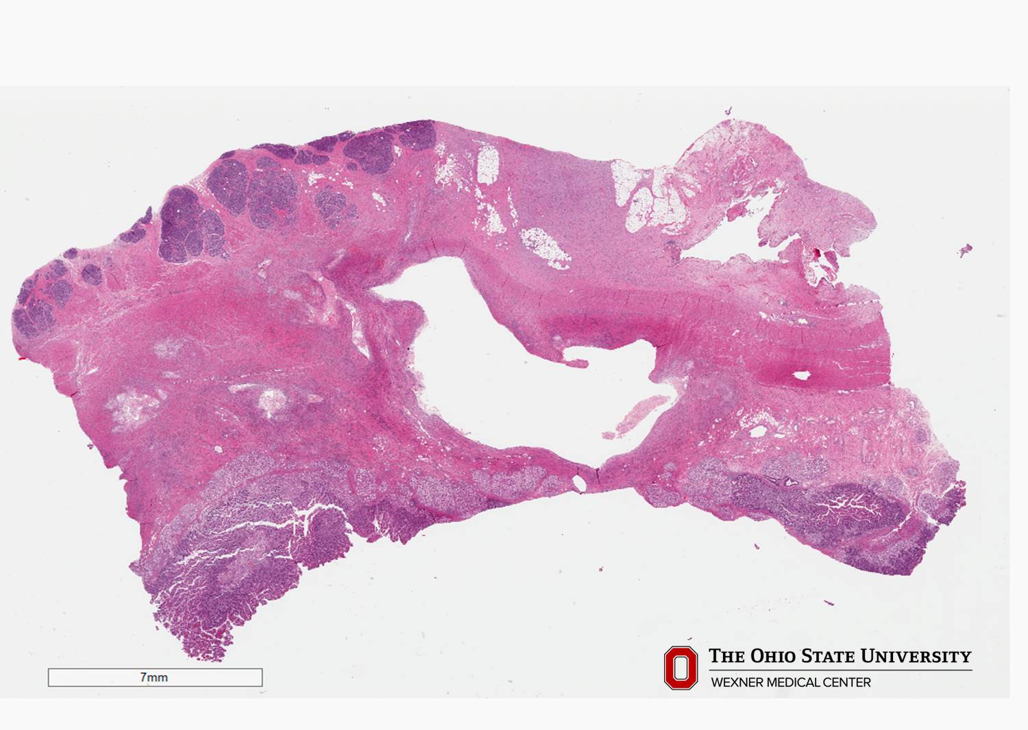 Microscopic image possibly detecting cancerous areas in human tissue