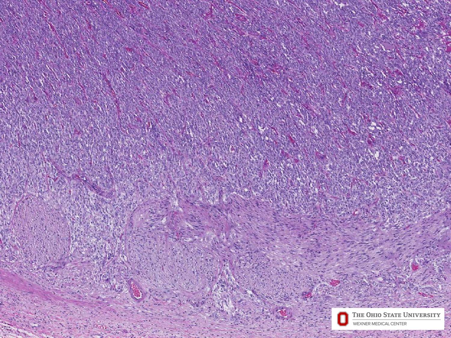 Microscopic image possibly detecting cancerous areas in human tissue