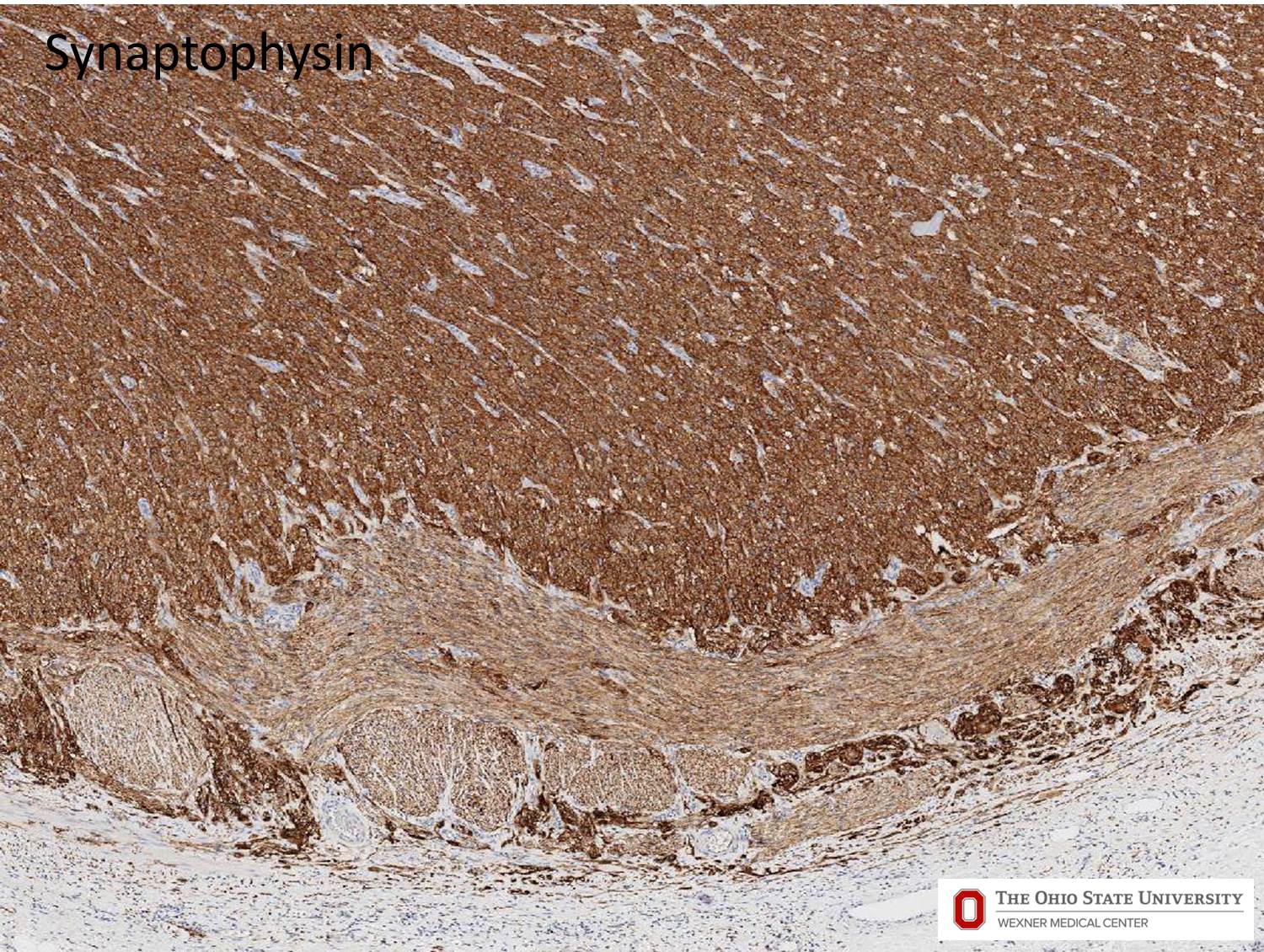 Microscopic image possibly detecting cancerous areas in human tissue