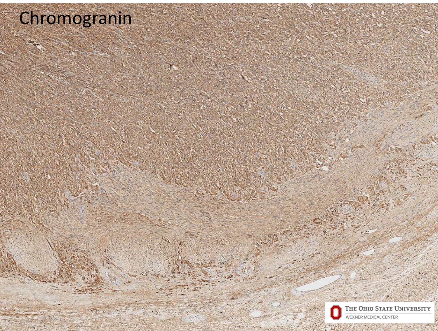 Microscopic image possibly detecting cancerous areas in human tissue