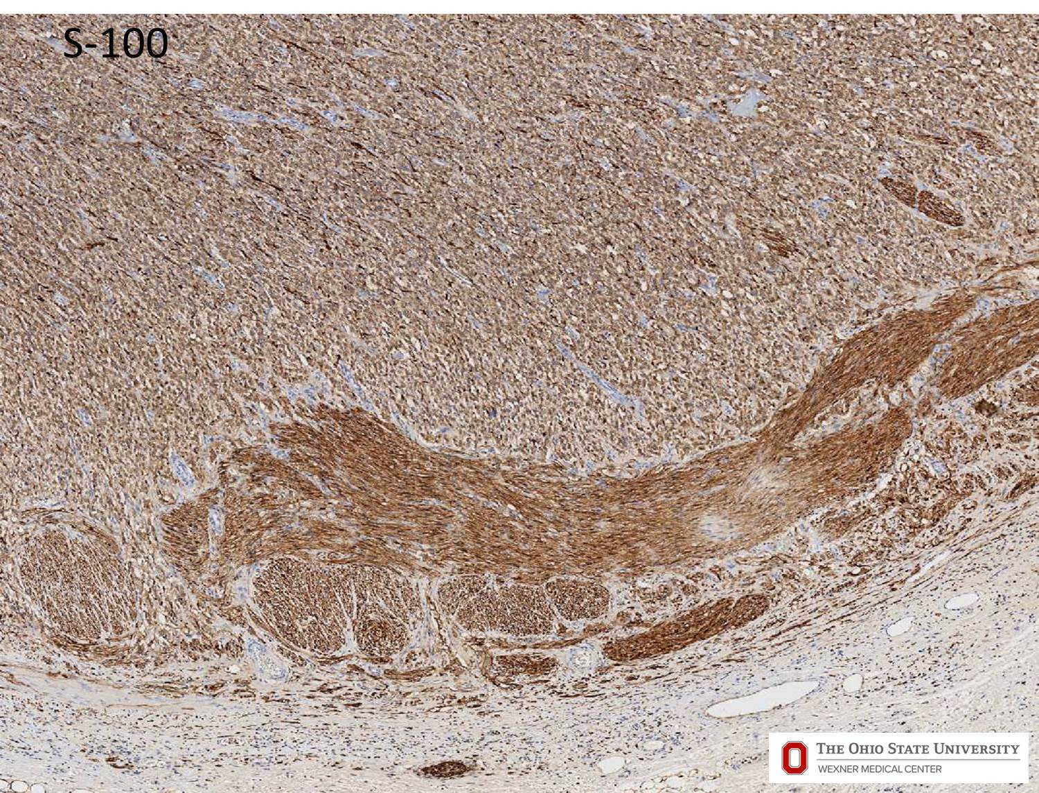 Microscopic image possibly detecting cancerous areas in human tissue