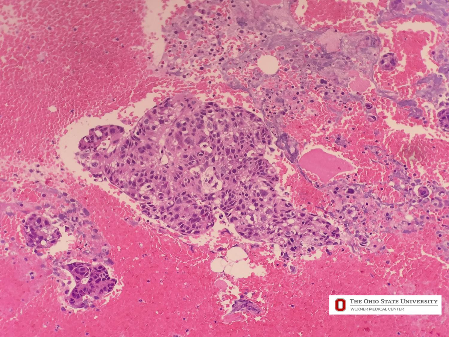 Microscopic image possibly detecting cancerous areas in human tissue