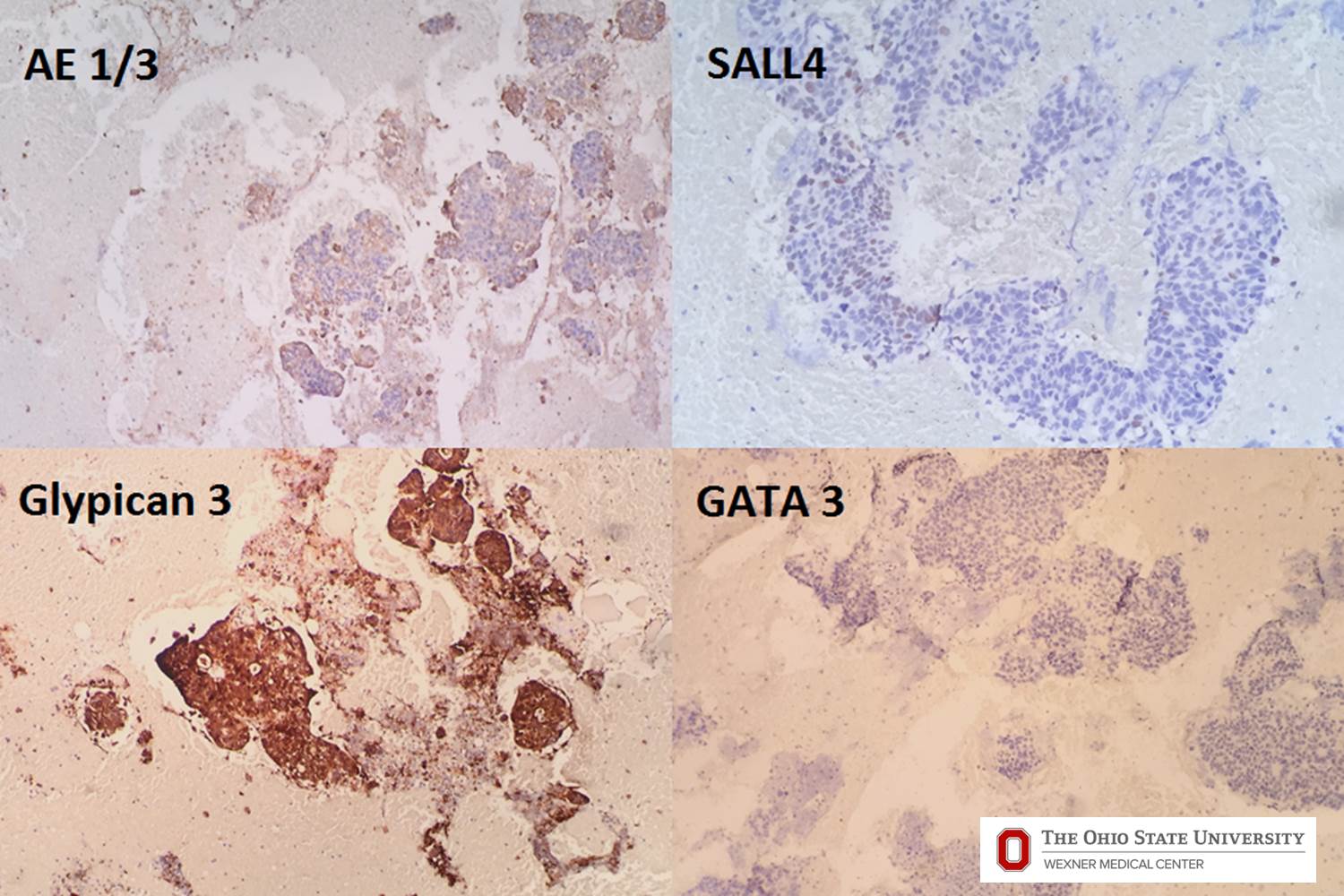 Microscopic image possibly detecting cancerous areas in human tissue