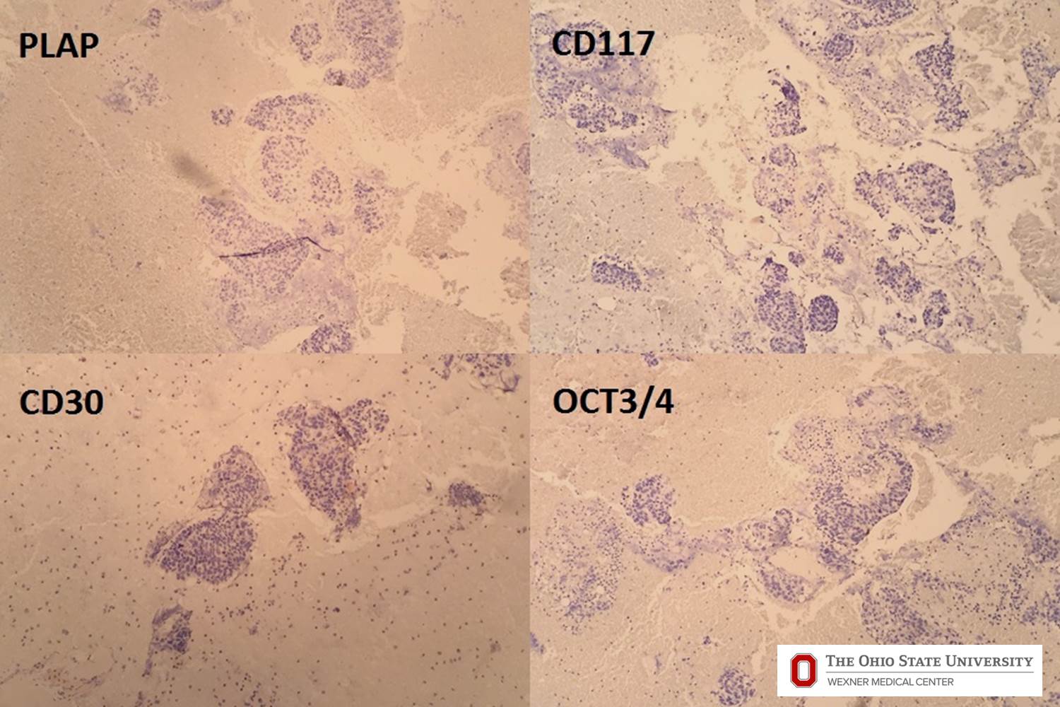 Microscopic image possibly detecting cancerous areas in human tissue