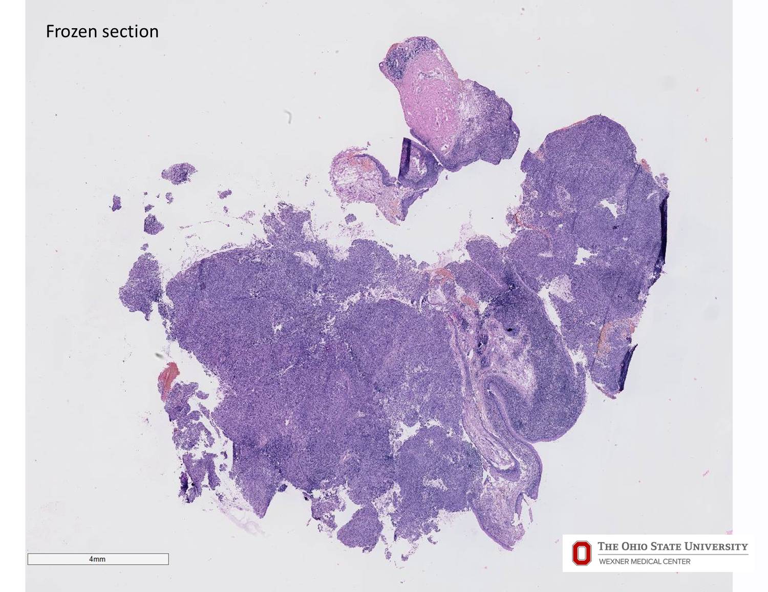 Microscopic image possibly detecting cancerous areas in human tissue