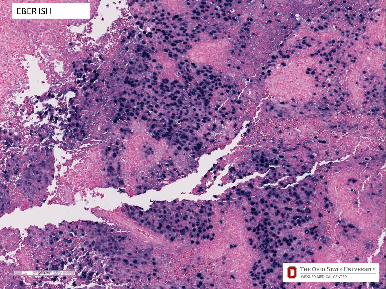 Microscopic image possibly detecting cancerous areas in human tissue