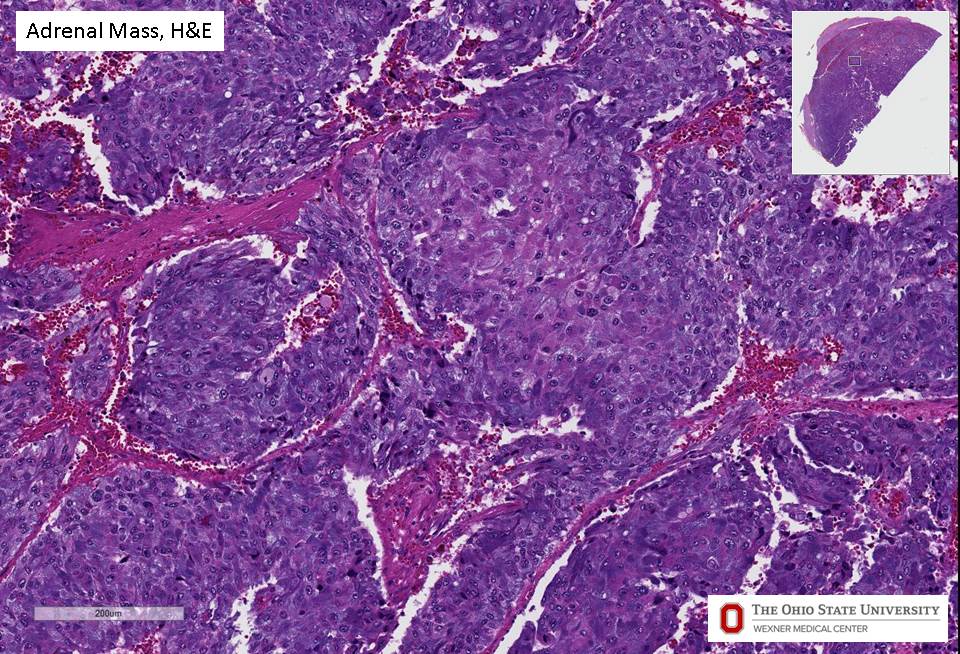 Microscopic image possibly detecting cancerous areas in human tissue